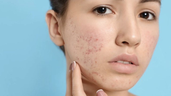 Same-Day Acne Appointment Near California Maryland